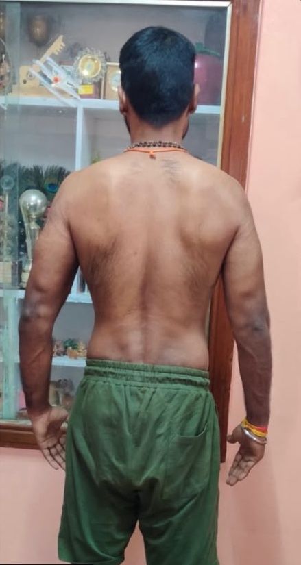 Fat loss, back: after