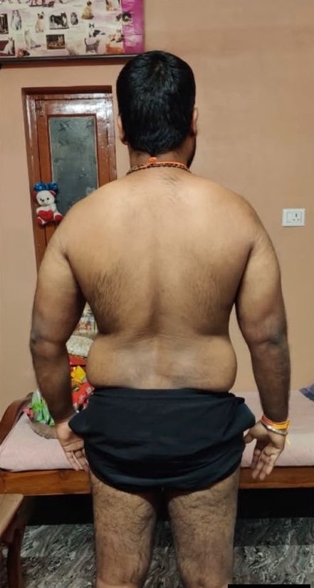 Fat loss, back: before